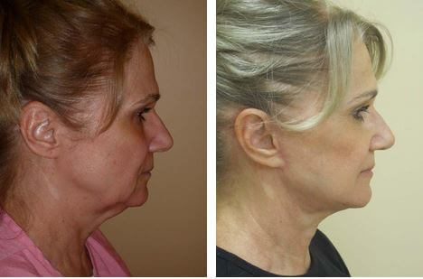 facelift procedure plymouth meeting