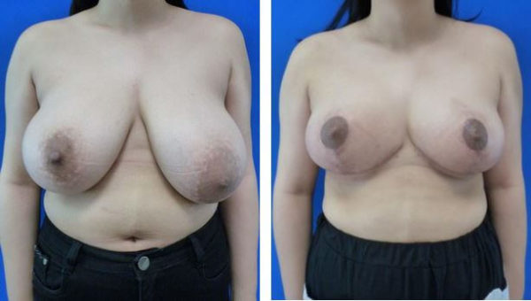 Breast Reduction Philadelphia