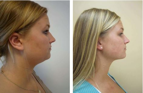 Will a Neck Lift Make Me Look Younger? | Plymouth Meeting Neck ...