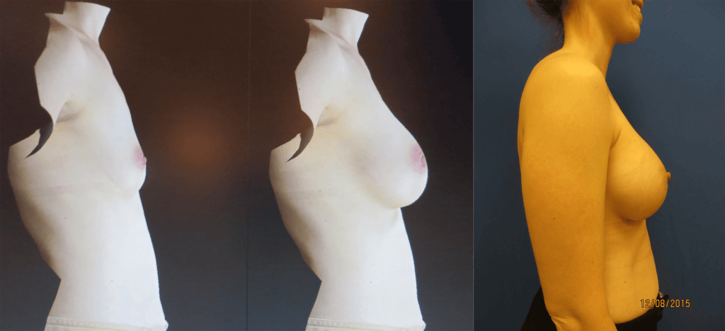 Vectra 3D Imaging for Breast Augmentation