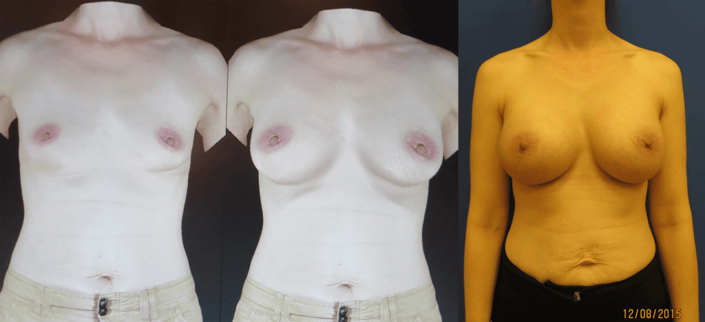 Vectra 3D Imaging for Breast Augmentation