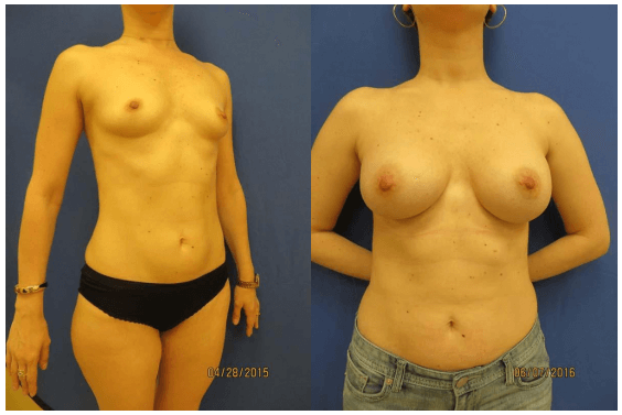 Breast Augmentation, Lift, and Reduction What are the Differences? Philadelphia Breast Augmentation The Pennsylvania Centre for Plastic Surgery