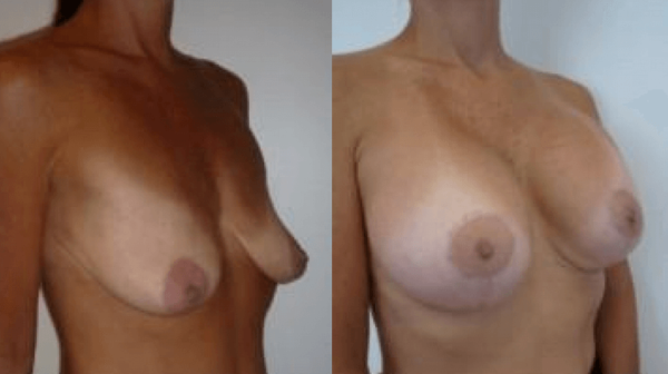 Plymouth Meeting Breast Lift